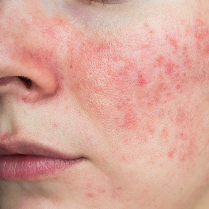 Irritates and Reddened